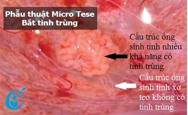 Phẫu thuật Micro-TESE vi phẫu tinh hoàn tìm và thu lượm tinh trùng