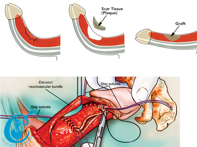 Minh họa điều trị cong vẹo dương vật bằng phương pháp phẫu thuật