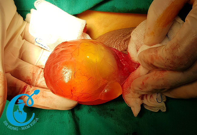 Hình ảnh phẫu thuật tràn dịch màng tinh hoàn