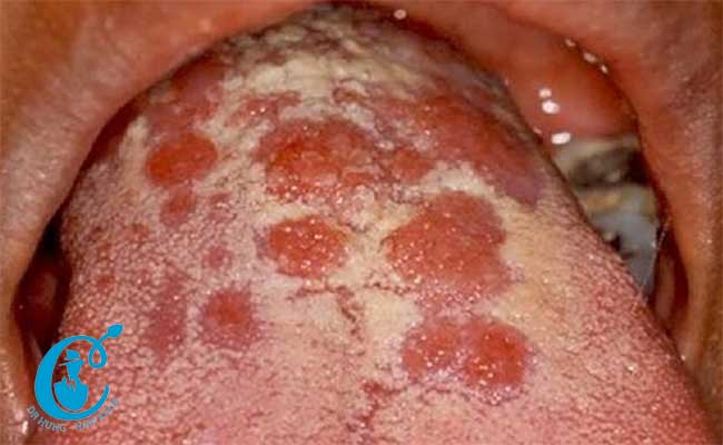 Tổn thương do bệnh giang mai xuất hiện ở lưỡi